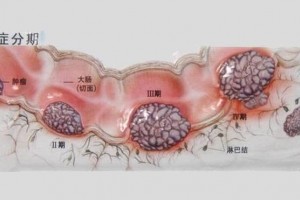 68岁肠癌晚期就诊，如果知道10大信号多好，可能已痊愈