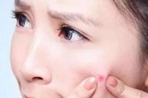 为什么湖南人吃辣不长痘真正加重皮肤疾病的其实是奶茶和甜食