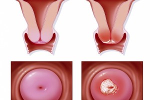 【宫颈癌】重视重视患癌年轻化