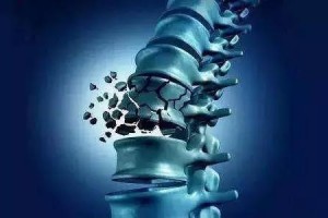 骨科大夫告诉您防治骨质疏松症的11点提示