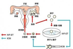 试管婴儿取卵当天注意事项有哪些