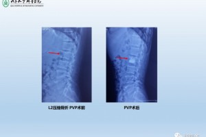 椎体成形术的操作技巧及要点看这篇就够了