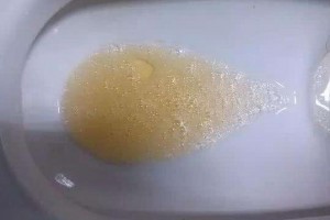小便有泡沫是不是患上肾病了这几个原因需要了解一下