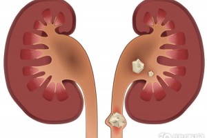 患上肾结石怎么办医生牢记3个禁忌有效避免结石长大
