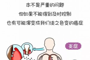 从炎症到癌症每一步都很阴险WT1肿瘤疫苗防备癌症