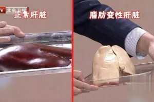 轻度脂肪肝也或许直接癌变这五大首恶能避开一个是一个做好三步助反转~
