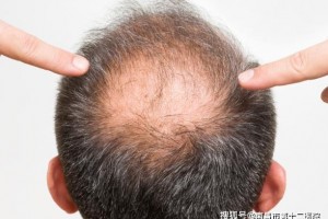 南昌市第十二医院植发对毛囊提取处有什么影响
