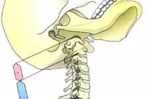 为什么颈椎不能随意按摩