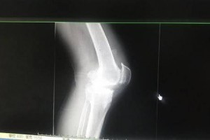 女子遇事故致11处骨折医师8小时手术出血仅400ml
