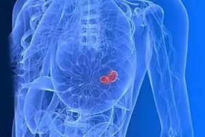 乳腺癌前期的3症状防备的3护理快来学习一下吧