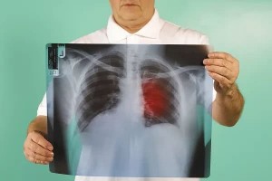 就在前天33岁男篮队长逝世为啥不抽烟的他仍是得了肺癌