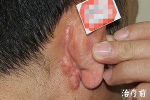 疤痕疙瘩怎样除掉8个有用的医治办法都在这儿了