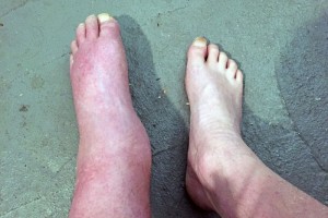 肾欠好这4个症状藏不住别比及尿毒症来了才看见