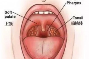 扁桃体总爱发炎怎样才能远离做好防备首要看这几点