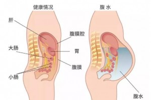 钟伟医师健康谈肝硬化腹水难治固执肝硬化腹水更难治看中医怎么辨证施治