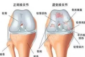 医师劝说别让你的膝盖老得比你还早用这几个办法保养你的膝盖