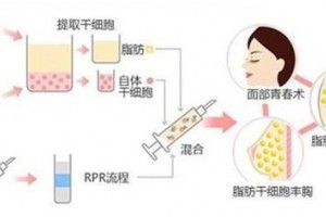 自体脂肪移植成活率是怎么回事怎样进步