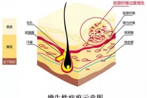 疤痕为何会越长越大