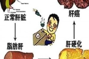 警觉中年油腻脂肪肝最喜欢赖上这些人