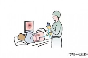 一次肠镜可保17年安全22类人群有必要赶快去做查看