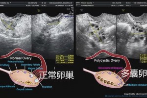 备孕患多囊卵巢的阅历美蕴莱角豆提取物饮品协助我收成了许多经历和心得