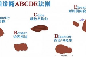 认为黑痣却是恶性黑色素瘤这种疾病常常被人忽视耽搁医治
