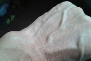 肝功能正常的人手上一般没这4种符号期望你一个也没有