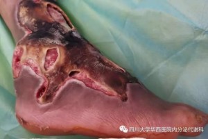 慢病院外延续性护理之——糖尿病足院外办理