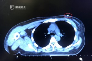 乳腺癌保乳术后怎么只留美丽不留危险
