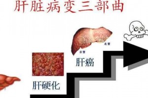 哪些原因能导致肝癌5类人高发呈现6个症状必定作4项查看