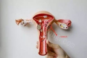 子宫腺肌病能治好吗