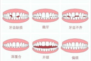 姜丹医师关于自锁托槽介绍