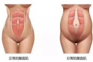 产后肚子又大又松我该怎么办