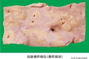 颈动脉斑块与内膜增厚有何损害防备的办法有哪些