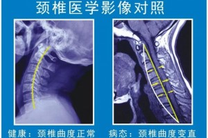 假如你有颈椎问题你就逃不开颈曲变直（附专业恢复计划）