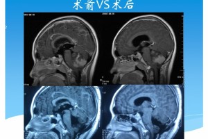 怎么进步儿童髓母细胞瘤的医治作用——医治关键及病例