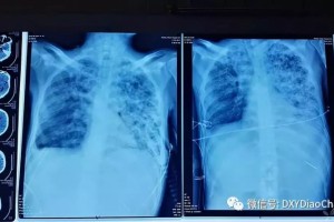 患者入院五天后逝世仅从胸片你能做出确诊吗