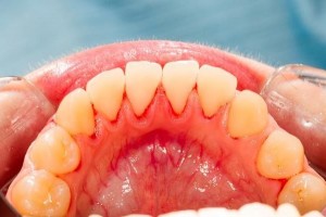 牙龈总出血是在暗示什么医师若扫除这5种病好好刷牙就行