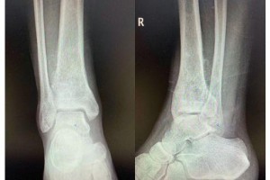 中年男子腿痛大半年一查竟是骨肿瘤