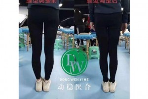下肢力线纠正练习