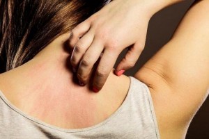春季荨麻疹三天两头来打扰这四个办法要紧记瘙痒一无再复发