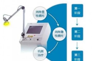 复发过四五次了尖锐湿疣患者的出路在哪里