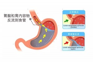 反酸烧心可能是胃食管反流防备有必要做好这6点